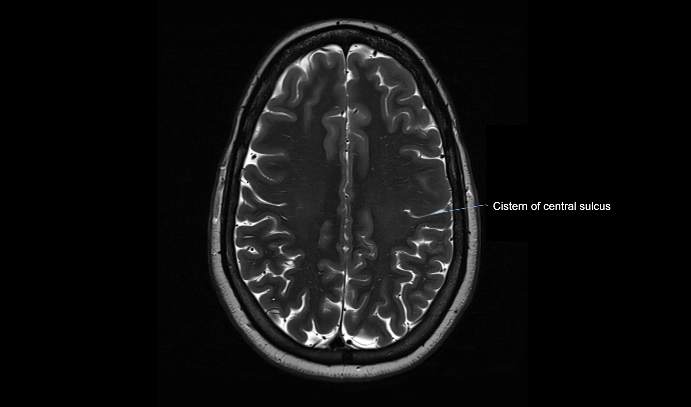 Brain cisterns  and ventricles  axial anatomy 3T MRI image-img-00001-00041.webp